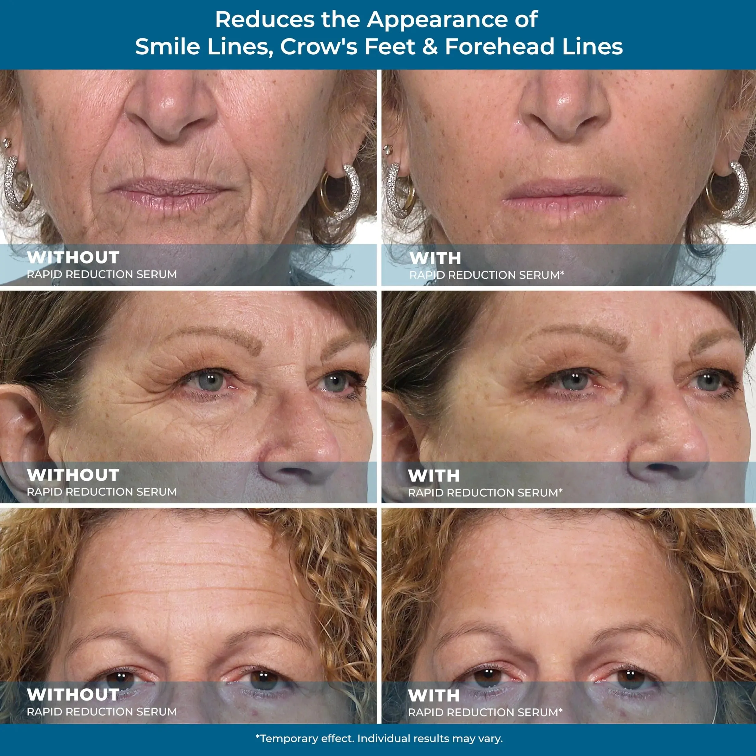 Plexaderm Rapid Reduction Eye Serum - Instant Wrinkle Remover for Under-Eye Bags, Fine Lines & Dark Circles